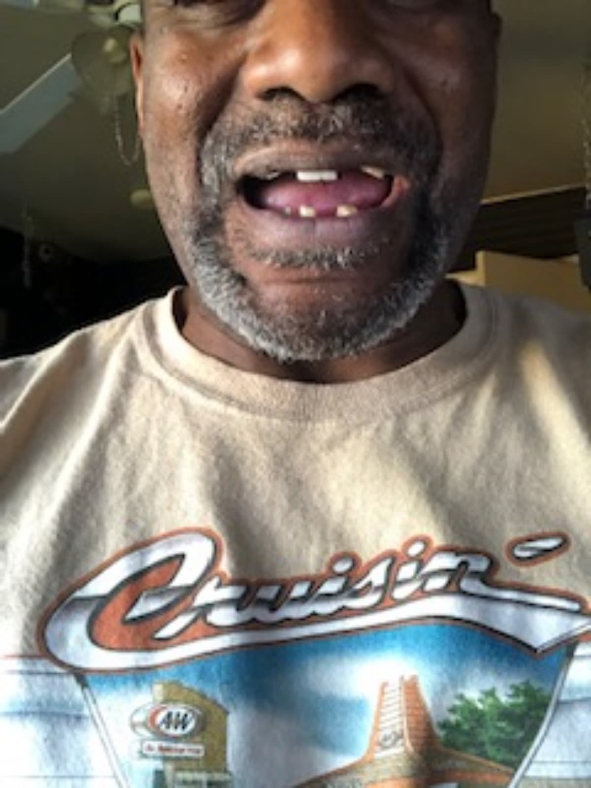 LostMyTeethToCovid19