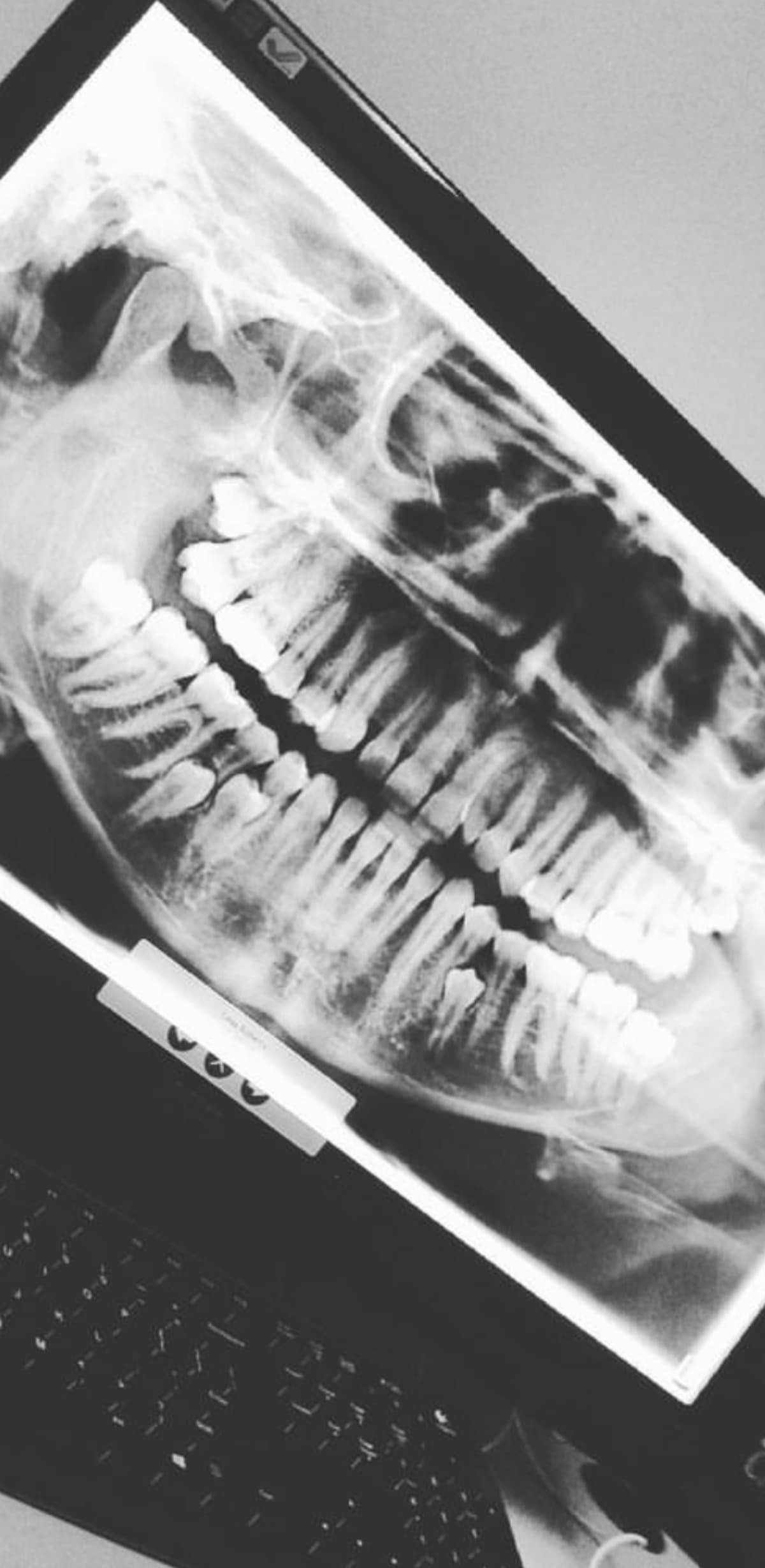 ExtraTeethAndJawSurgery