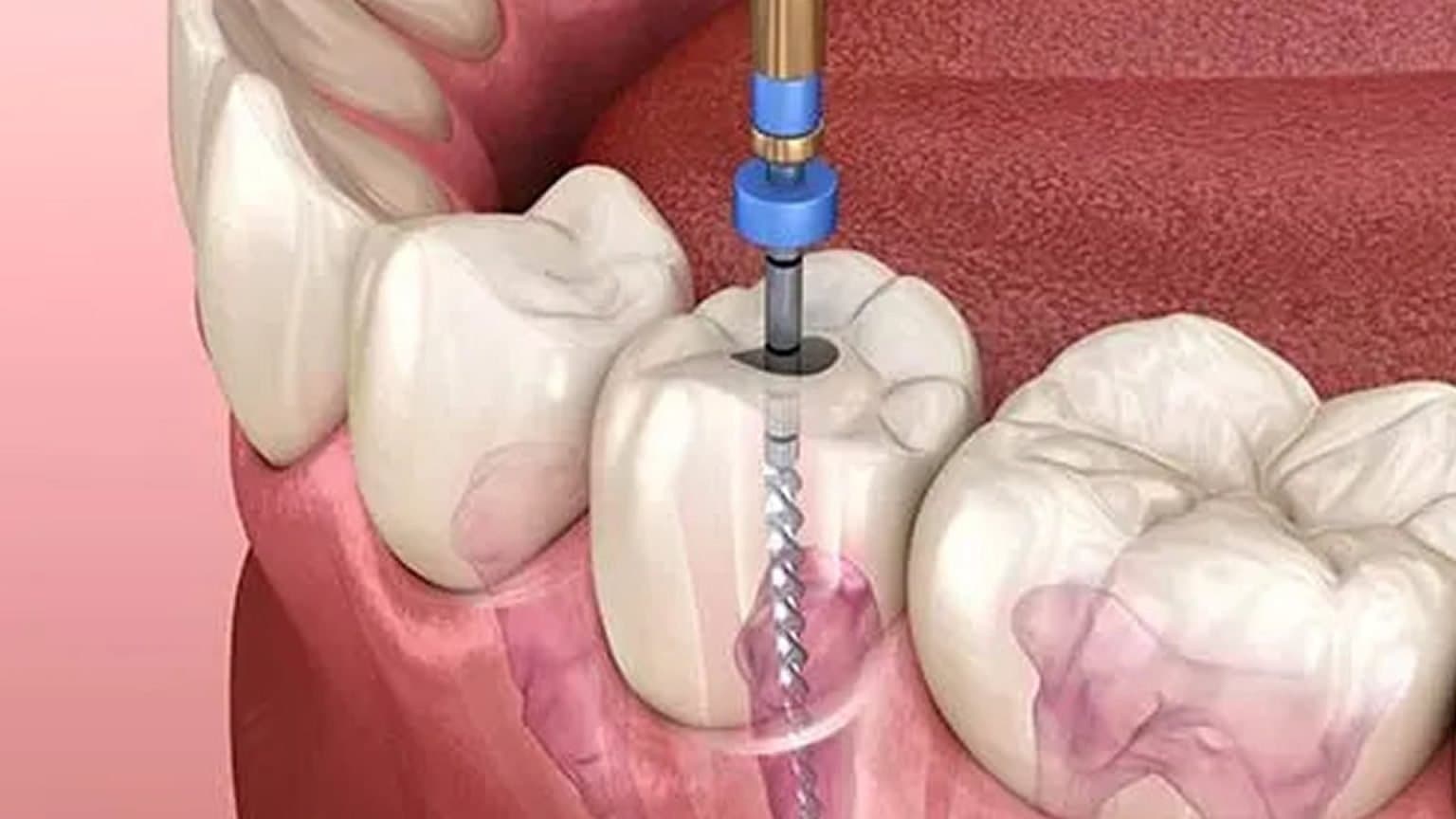 Understanding The Causes And Treatment Of Tooth Pulp Damage