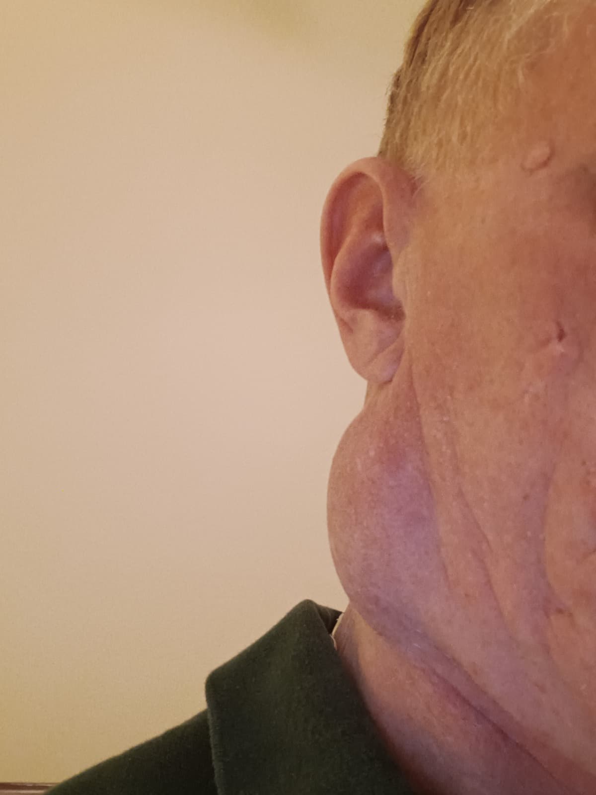 Stage4MelanomaCancer
