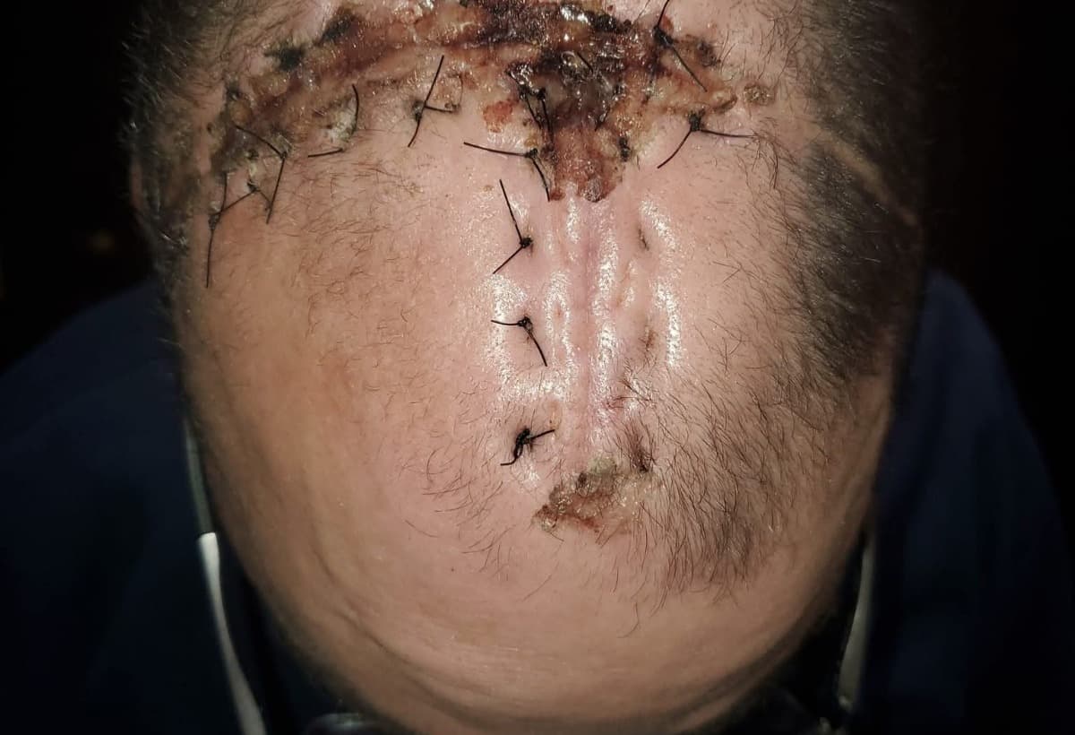 AFatherFightingGlioblastoma