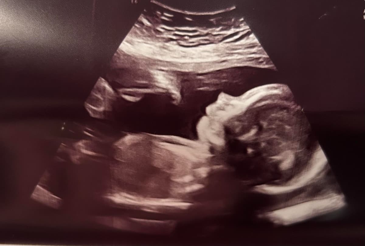 BabyAlexandersHeartSurgeries