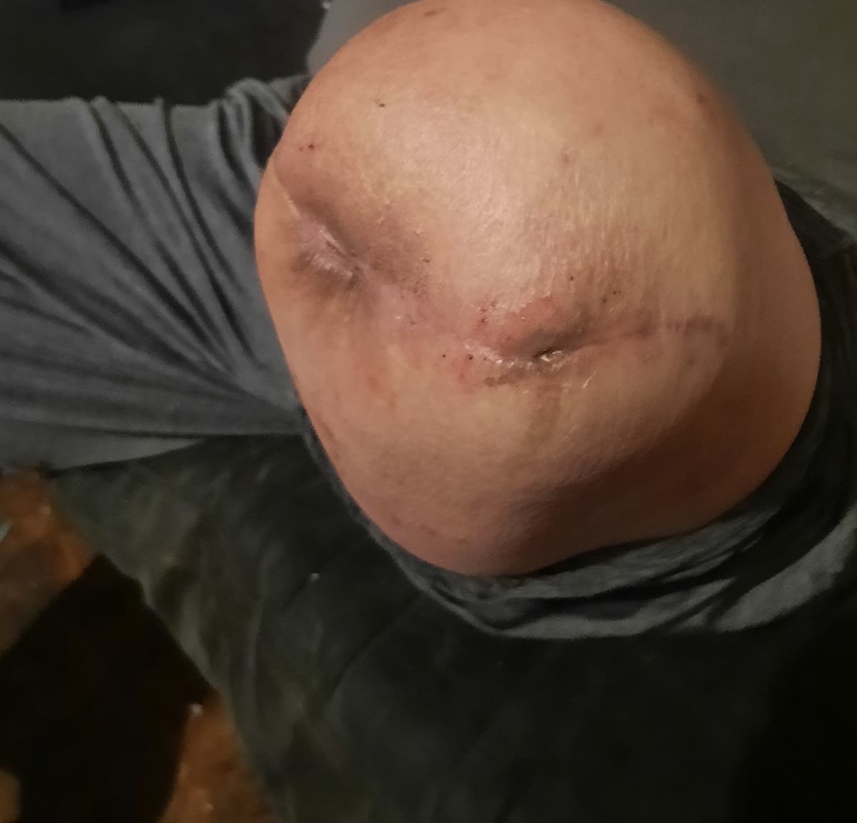 NeedAProstheticLegForMyHusba