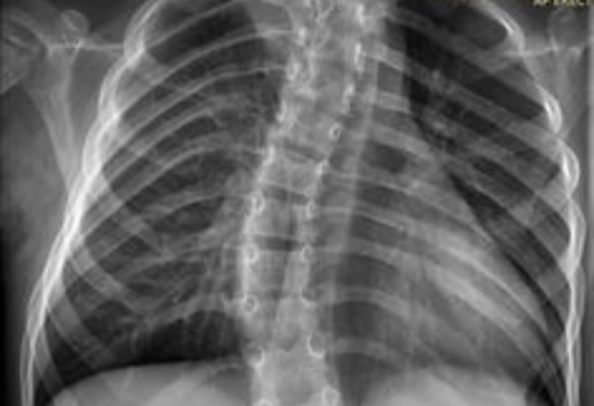 JAISONScoliosisResearch