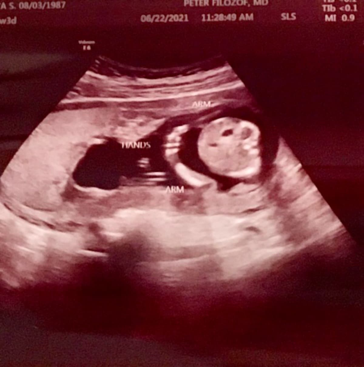 PregnancyBedRest