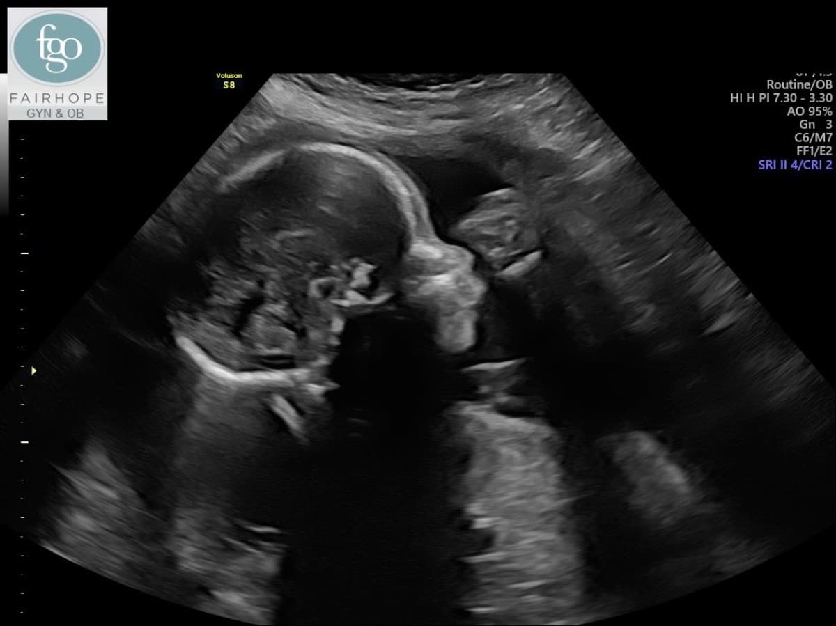 BabyLyriqsHeartSurgery