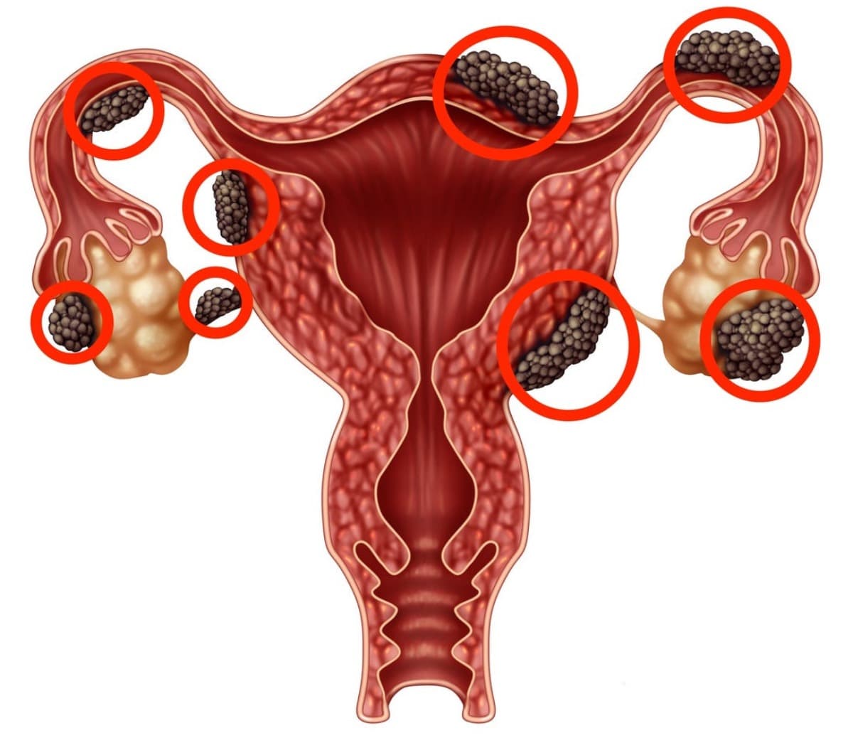 EnbyEndometriosisHysterectomy
