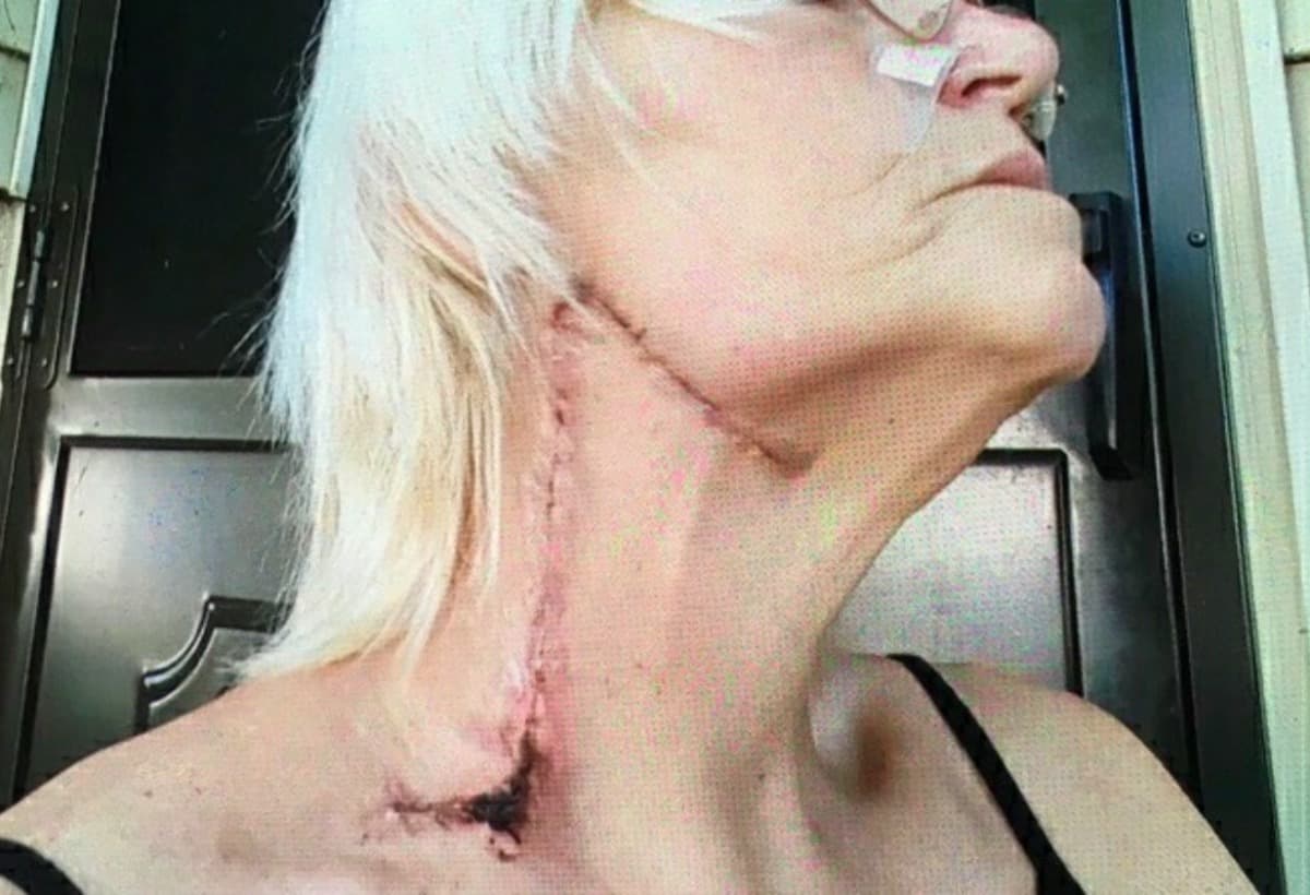 MetastaticMalignantMelanoma