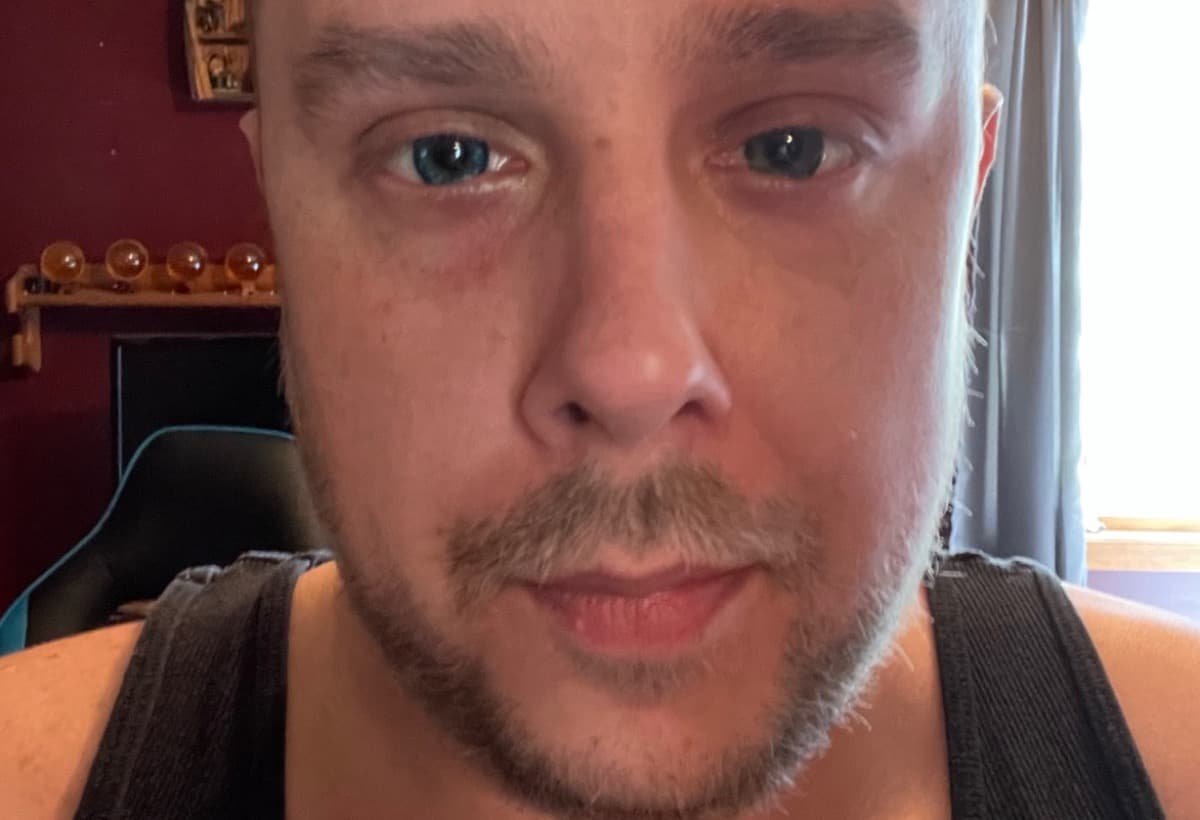 SarcomaCancerPatient