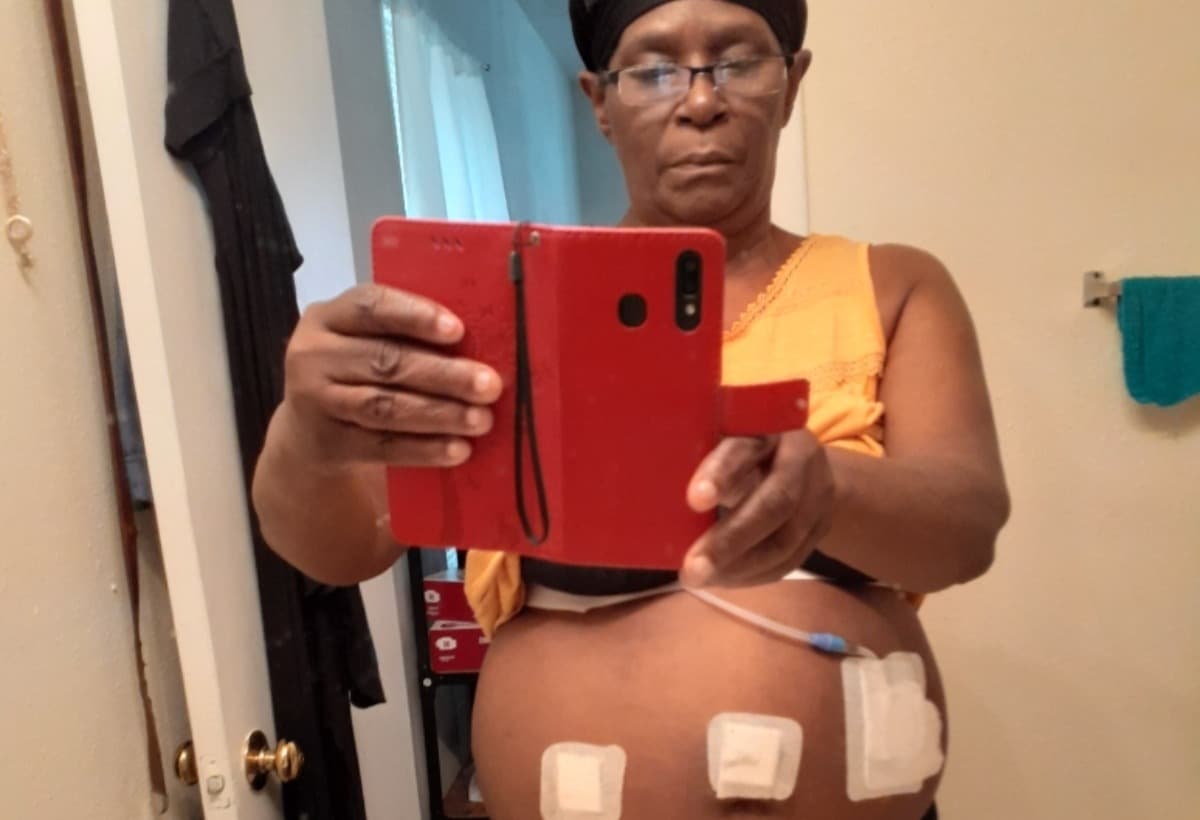 KidneyTransplantForTiny