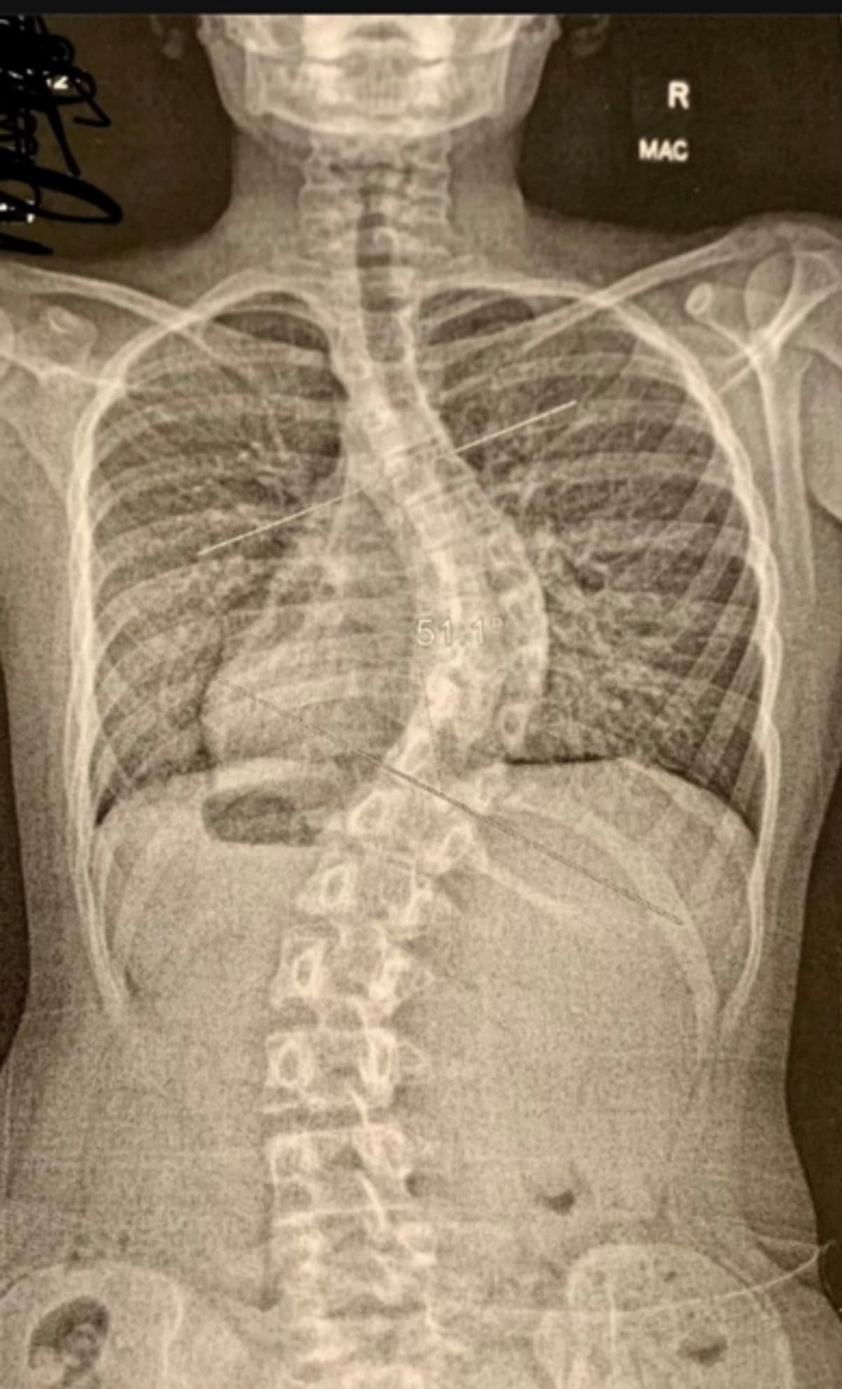 MedicalExpensesForDakota