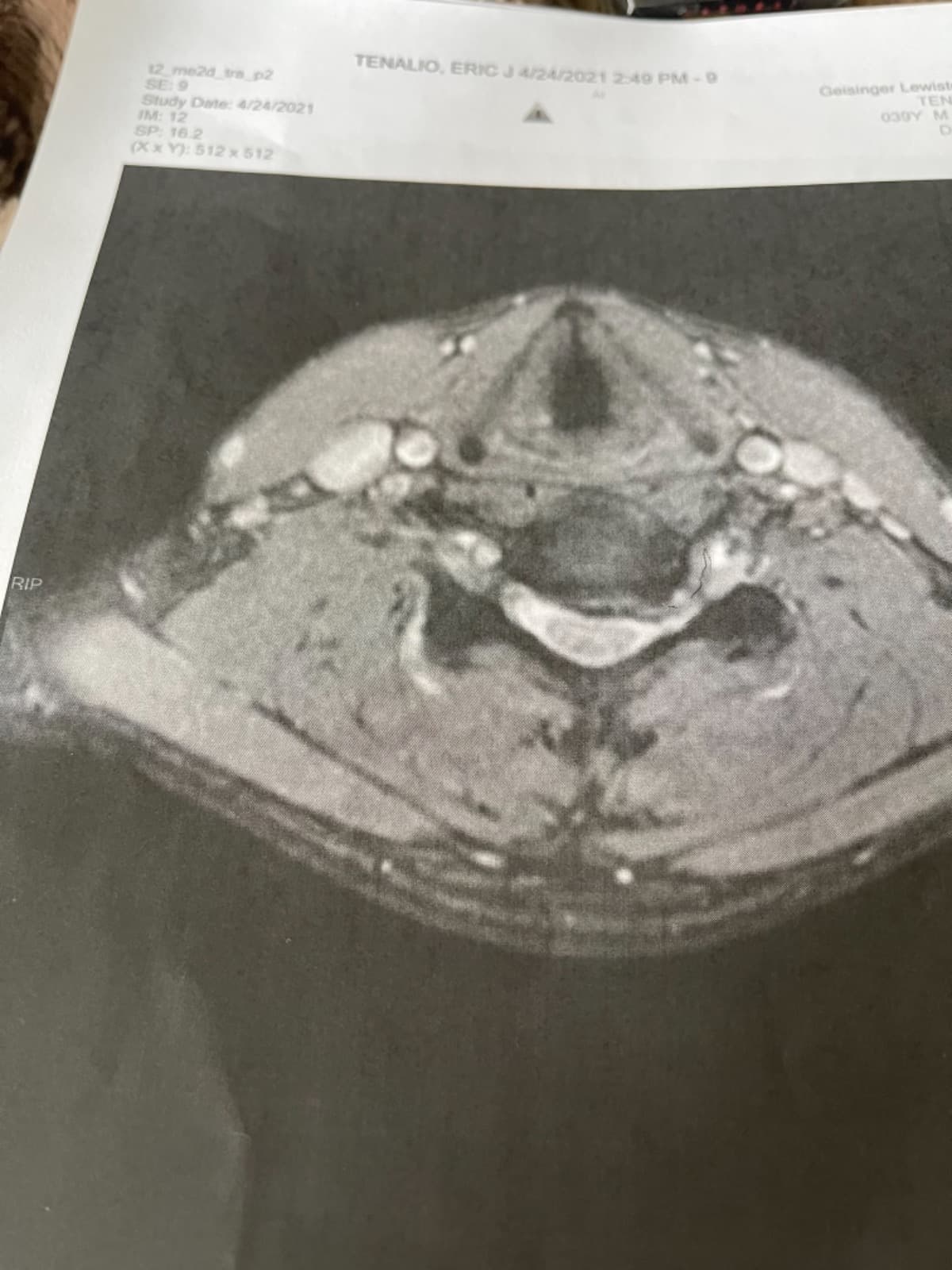 SpinalSurgeryLegalFees