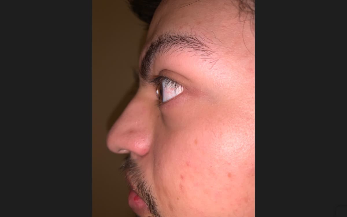 CorneaTransplantSurgery