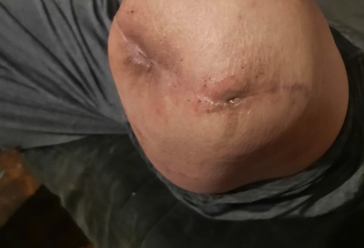 NeedAProstheticLegForMyHusba