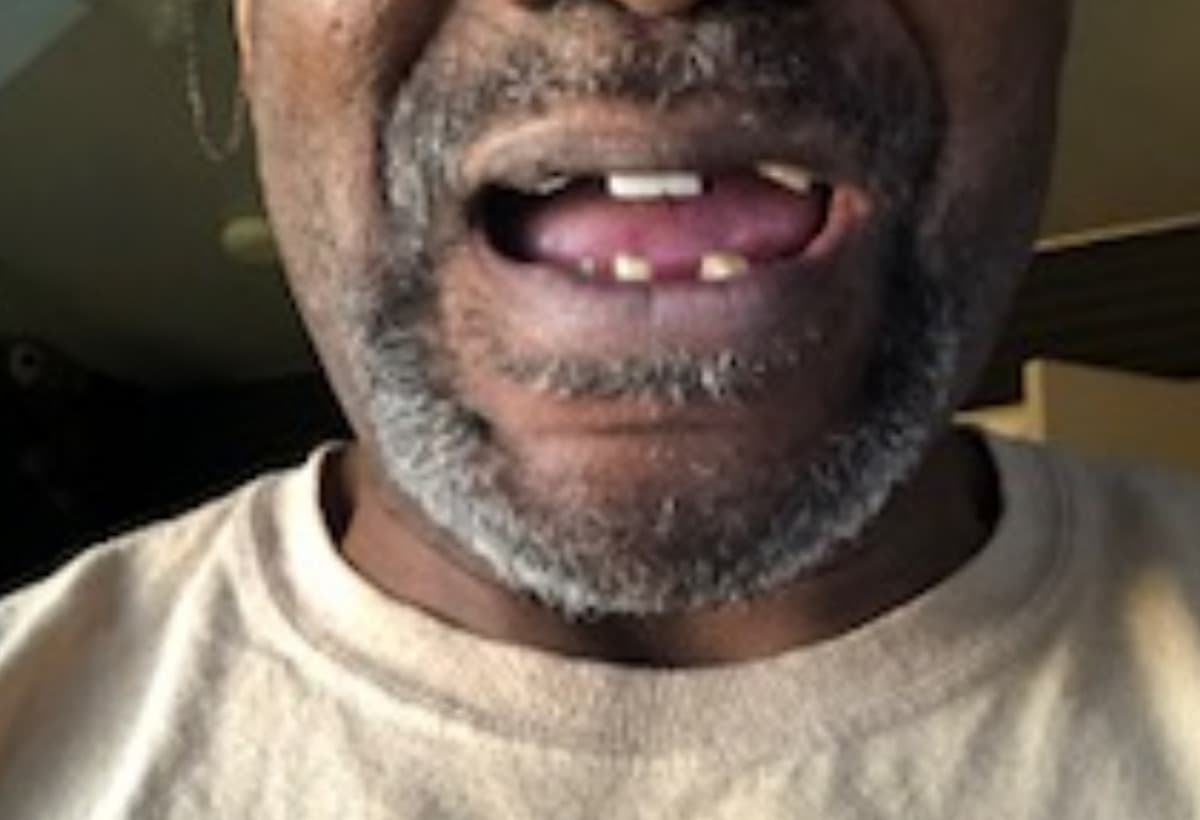 LostMyTeethToCovid19