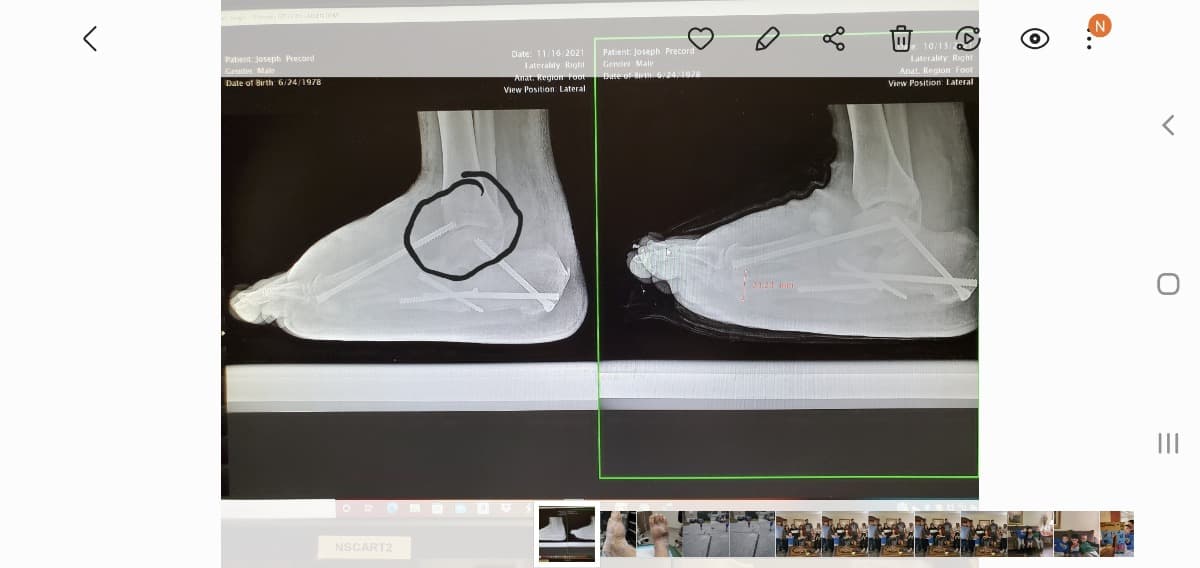 JosephPrecordFootSurgery