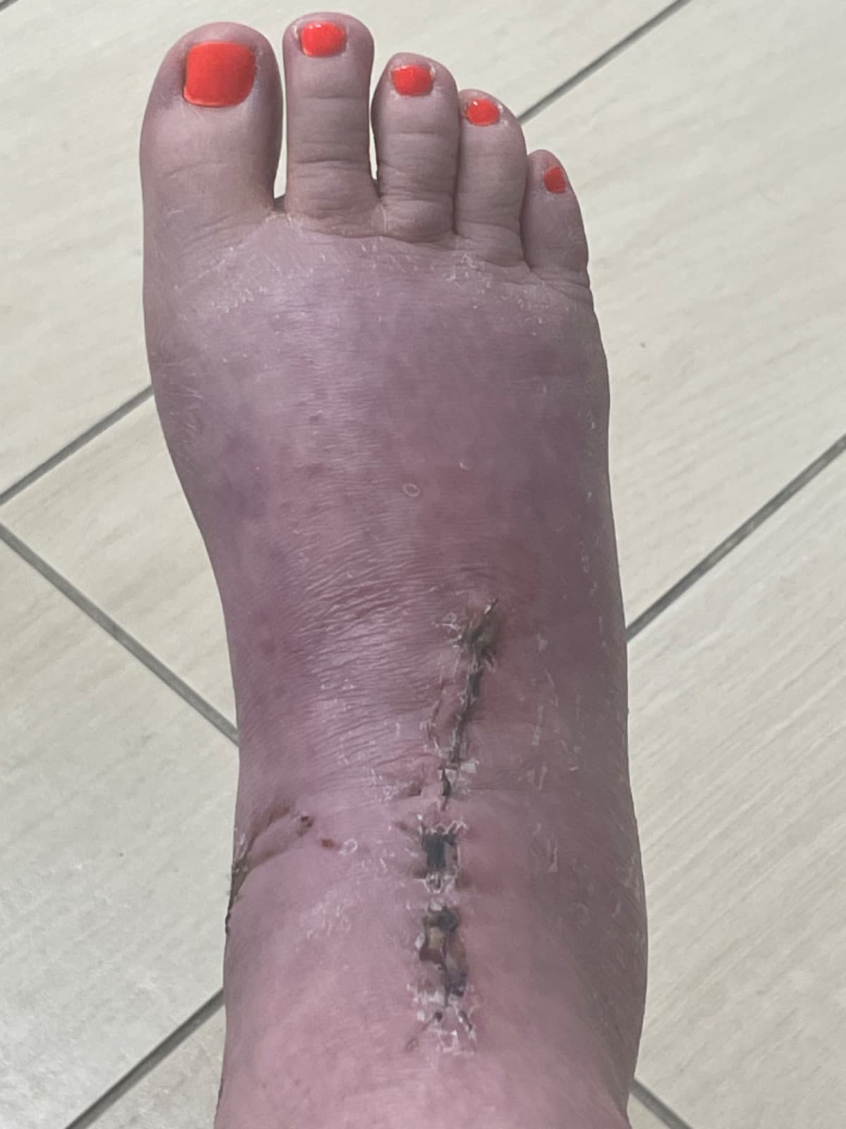 HelpFor4thAnkleSurgery