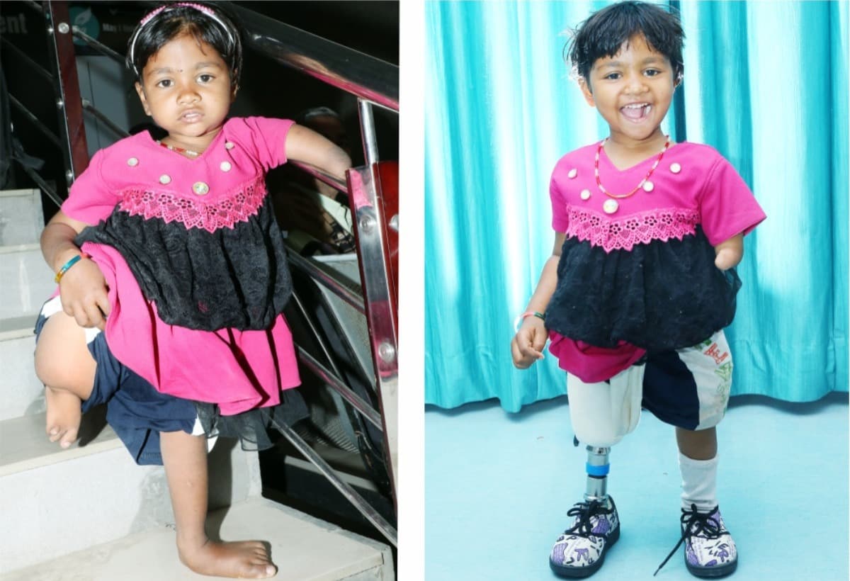 GiftAnArtificialLimb