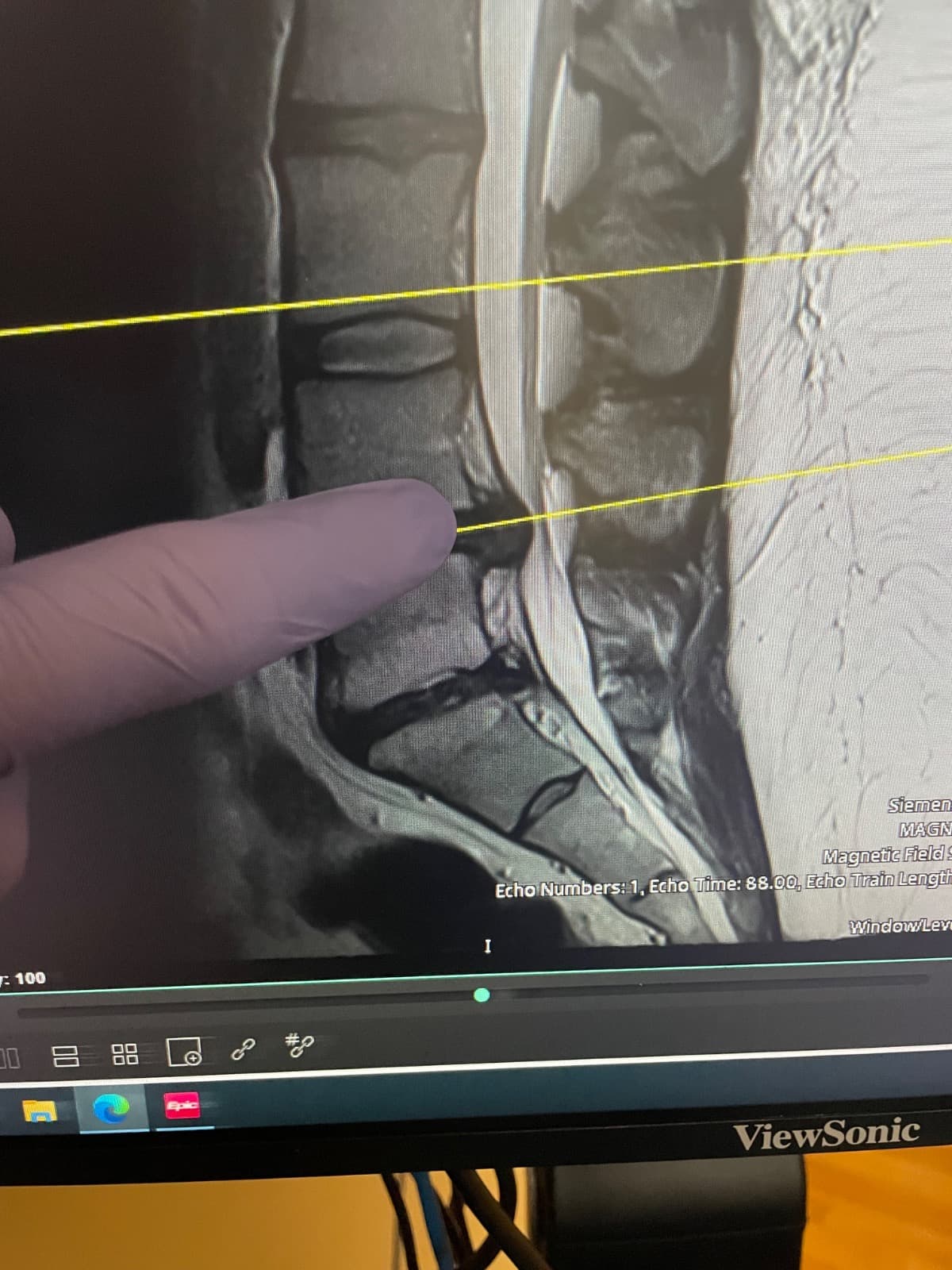 BrittanysLifeChangingSurgery