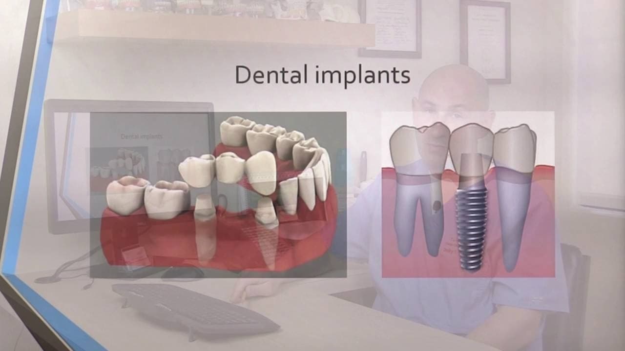 Implantate Wien: Die Beste Lösung Für Fehlende