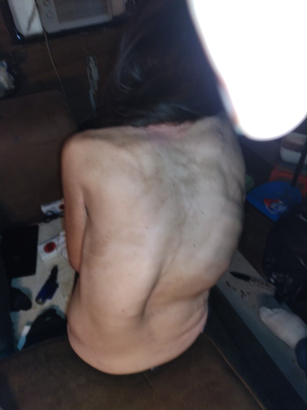 LivingWScoliosisAndKyphosis