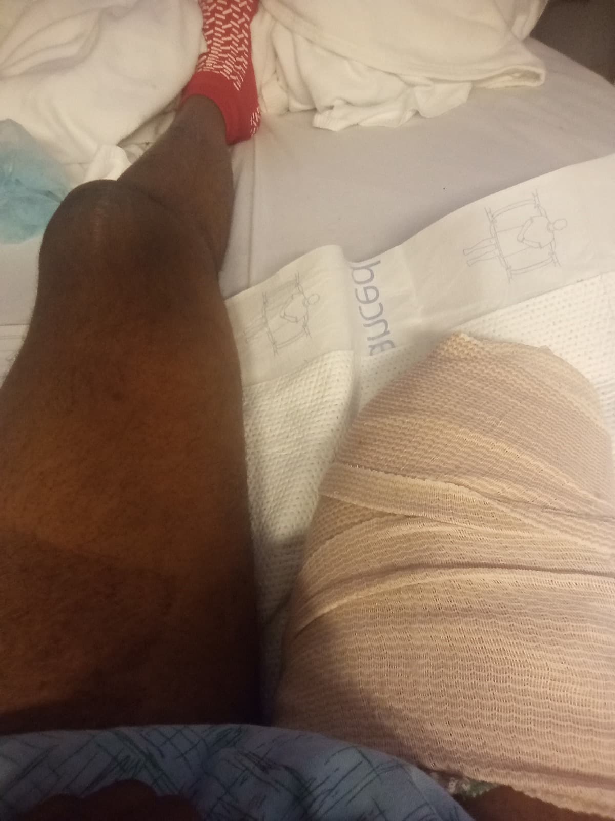 NewProstheticLegForBryan