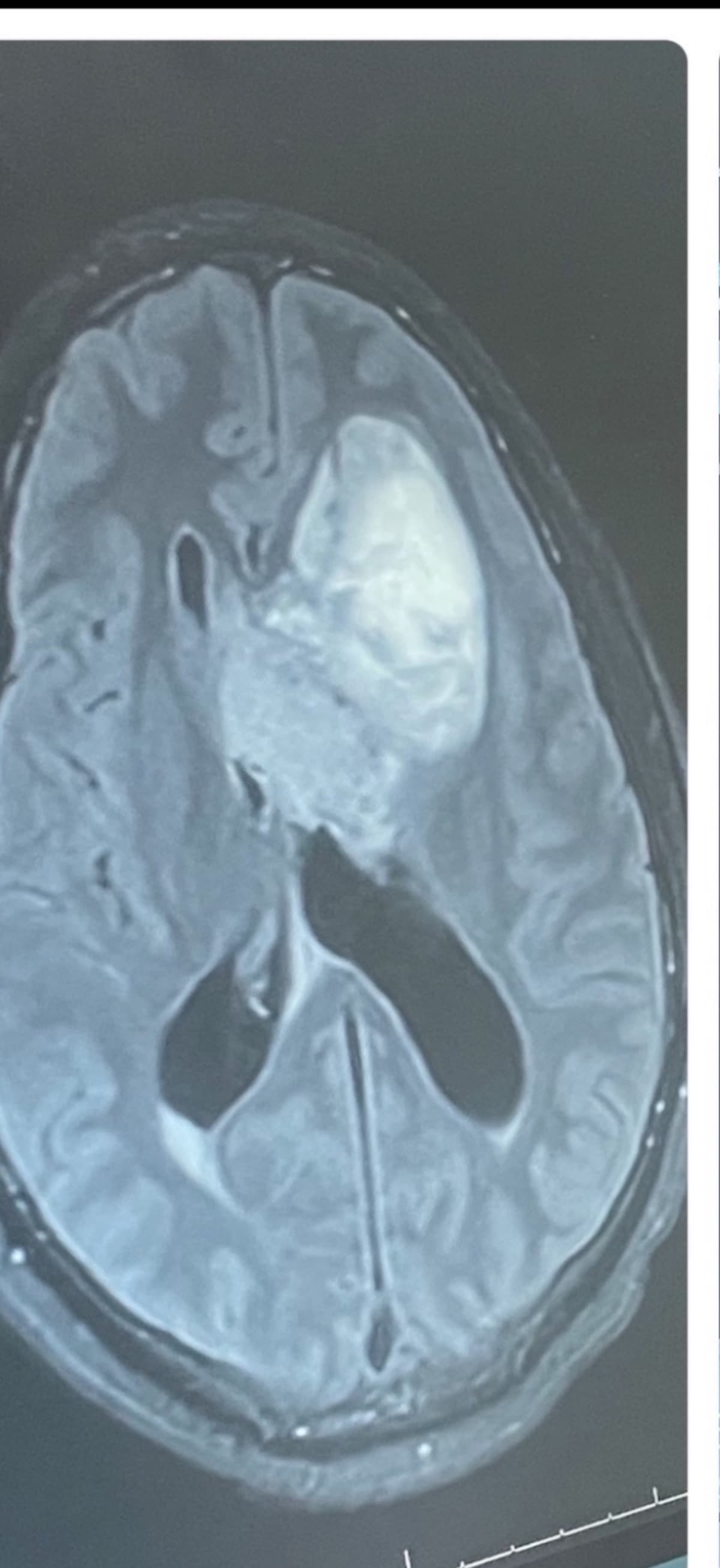 DontesGliomaTumorFight