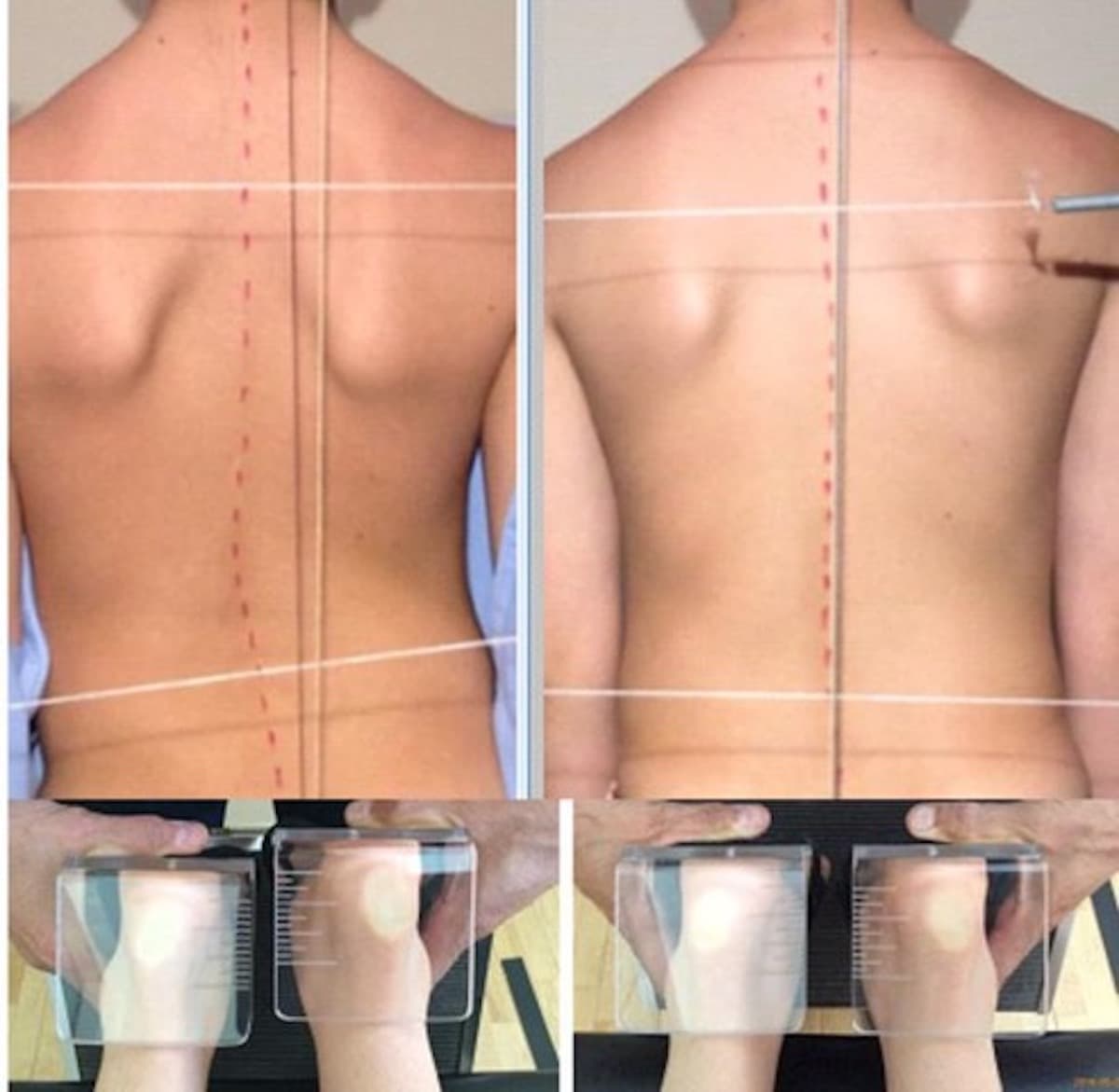 JAISONScoliosisResearch