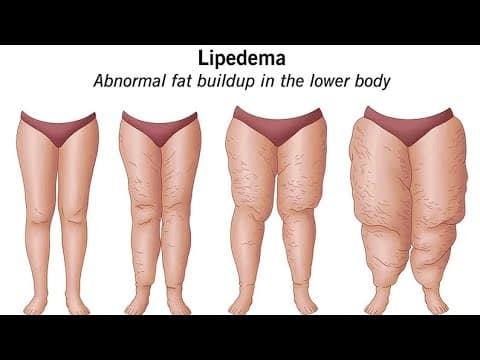 MyLipedemaSurgeries