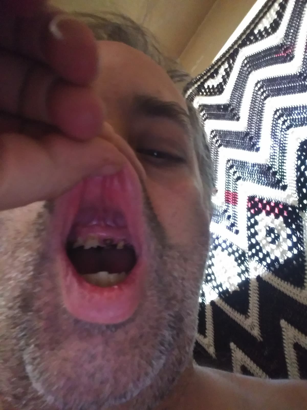 NewTeethForAChef