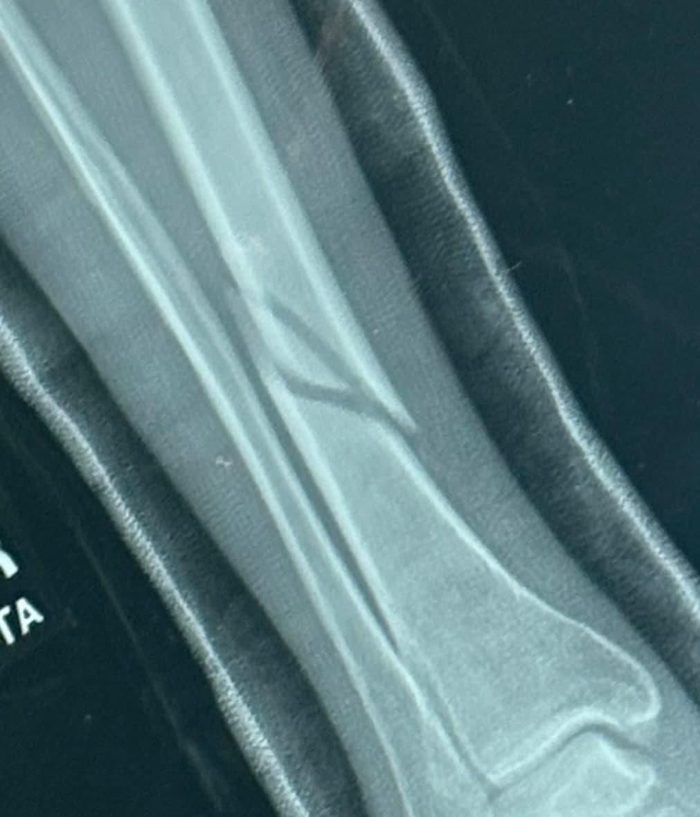 Broken Leg Surgery