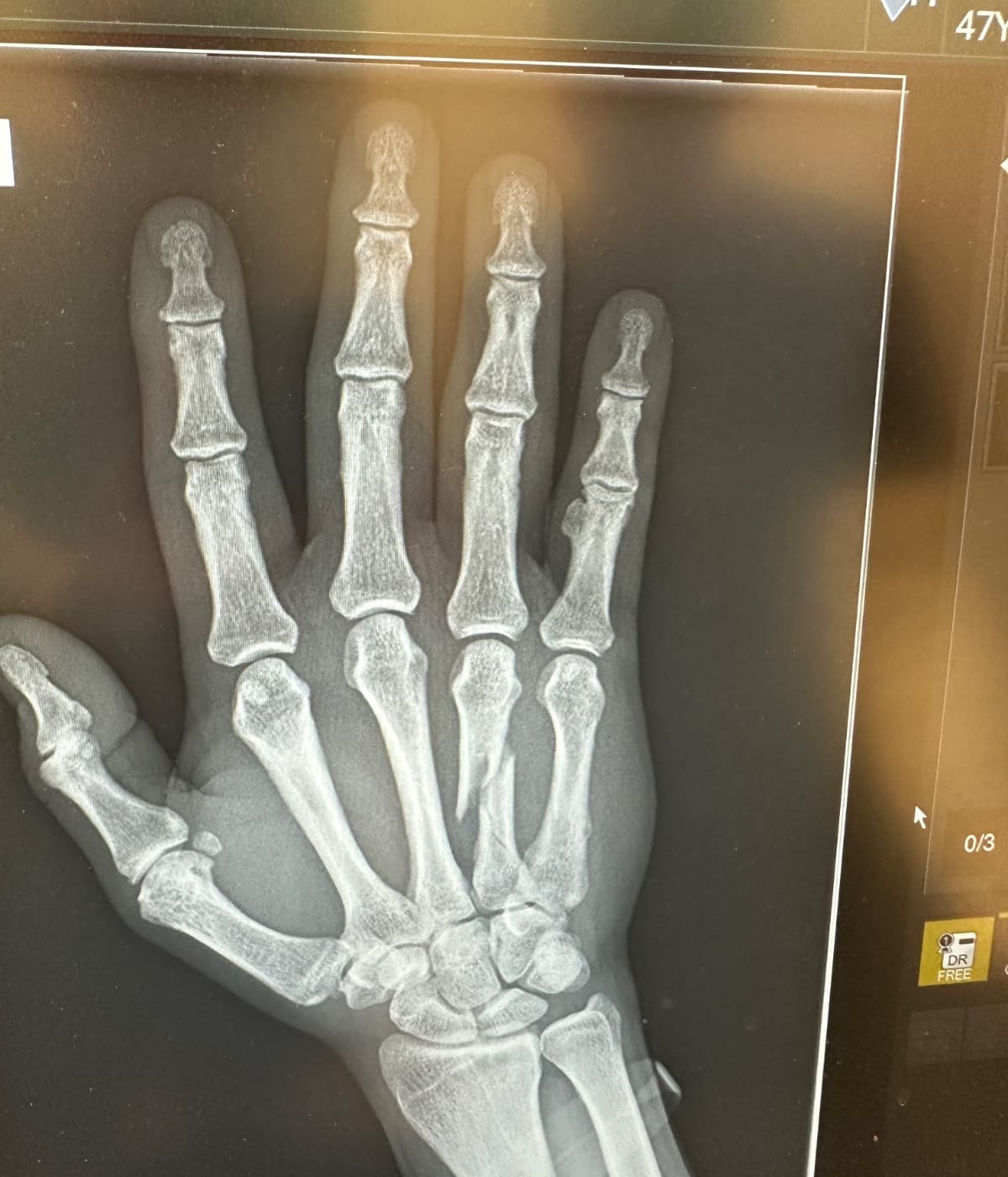 Help Fund My Hand Surgery Recovery