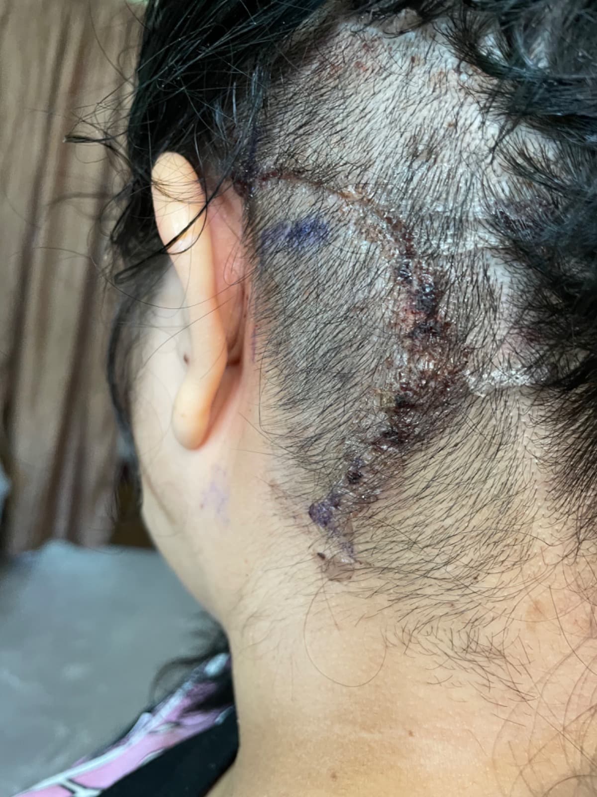 BrainTumor