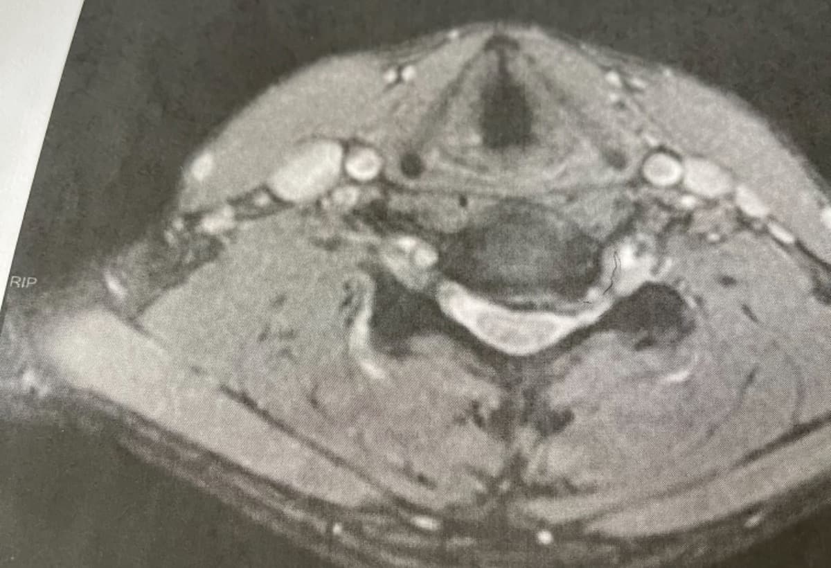 SpinalSurgeryLegalFees