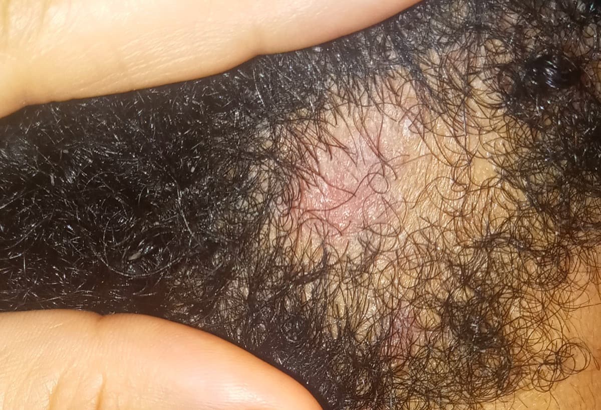 HelpHairLossAndScalpDisease