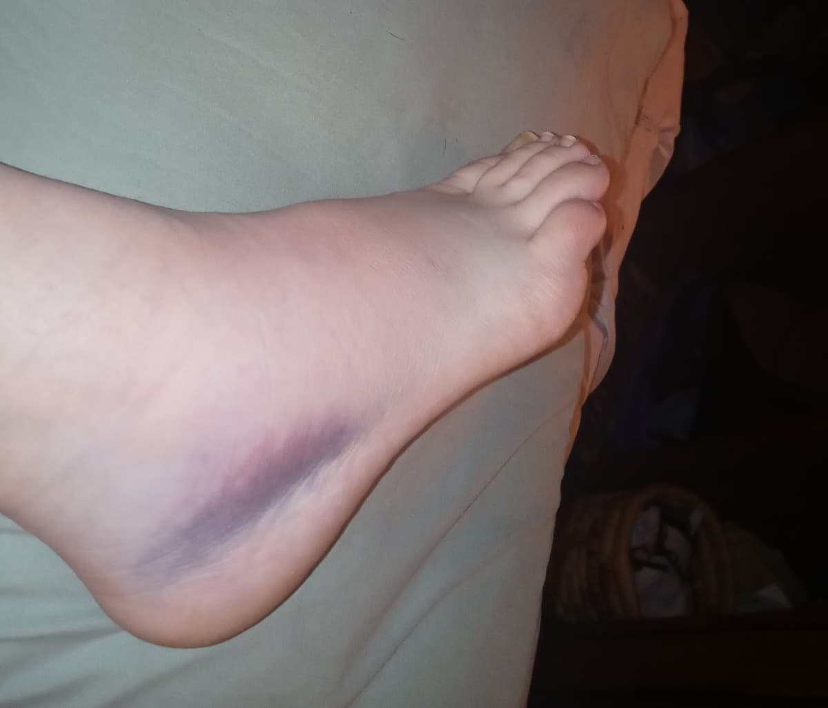 PleaseHelpBrokeFootNeedHelp