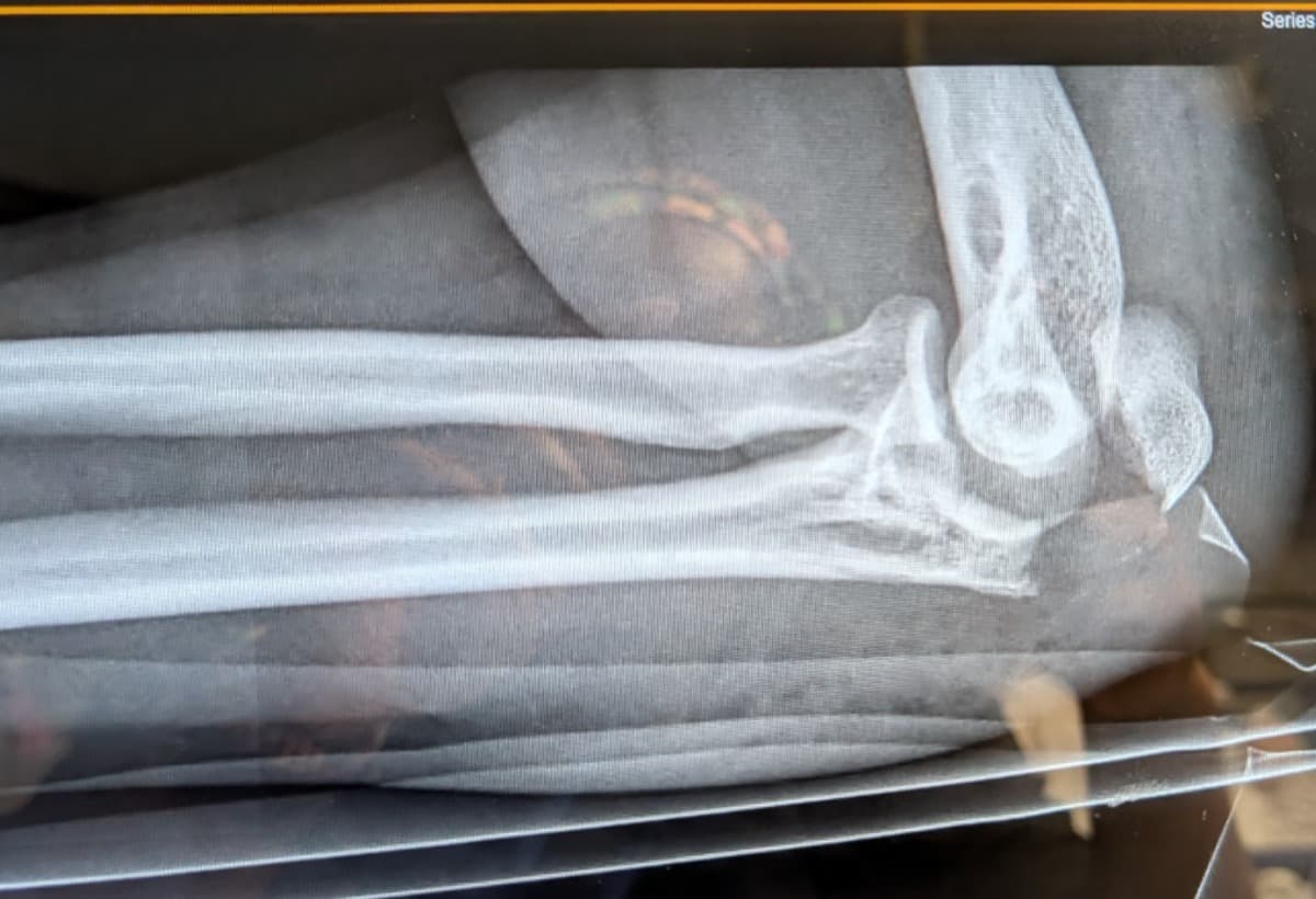 ShatteredElbowRecoveryFund