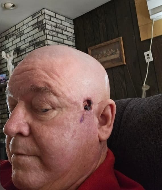 Dad's Skin Cancer Surgery