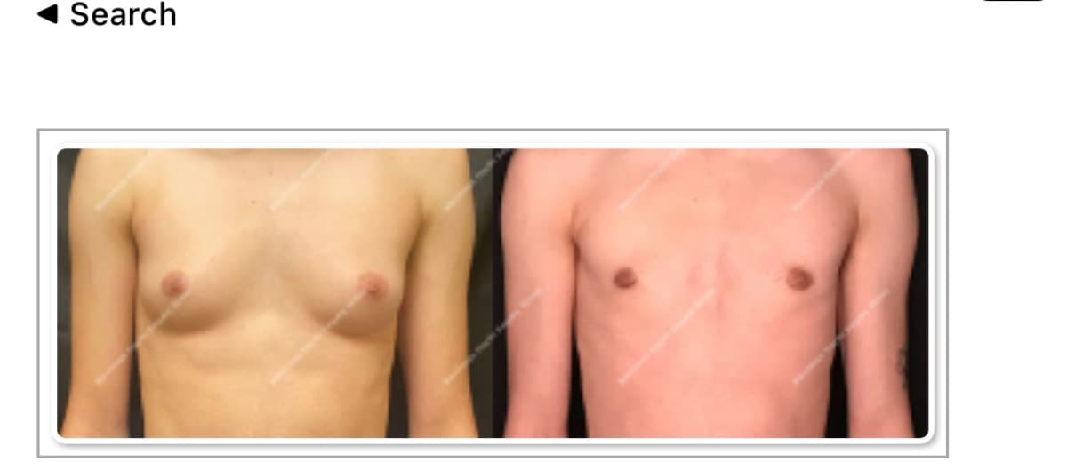TONGUEVORESTOPSURGERY