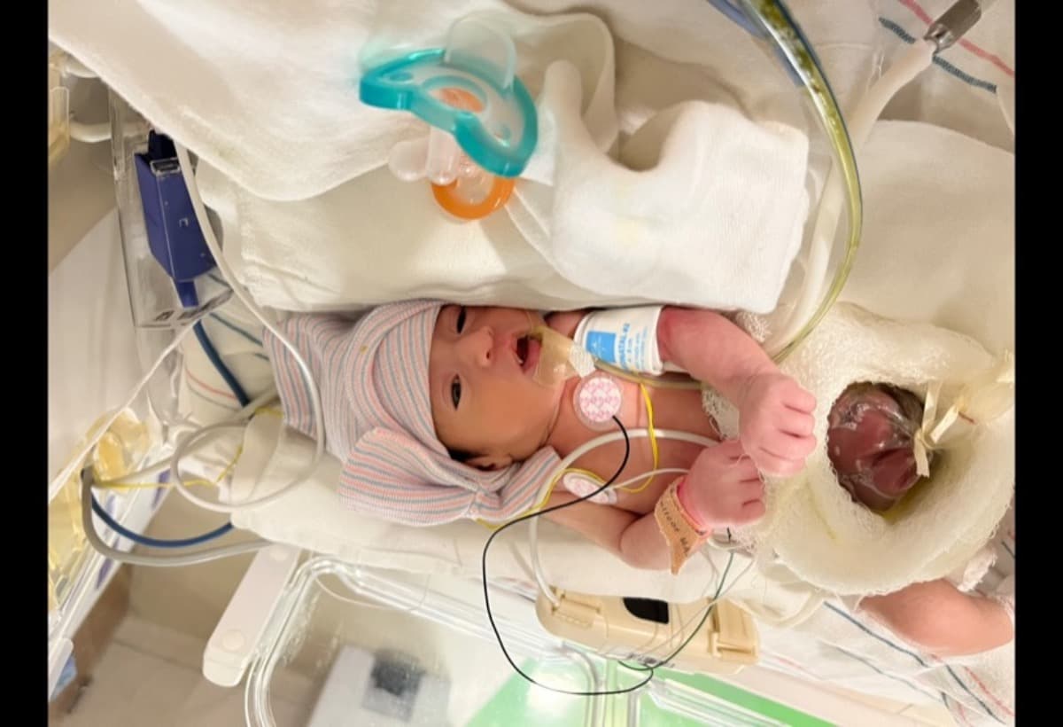 NewbornWithGastroschisis