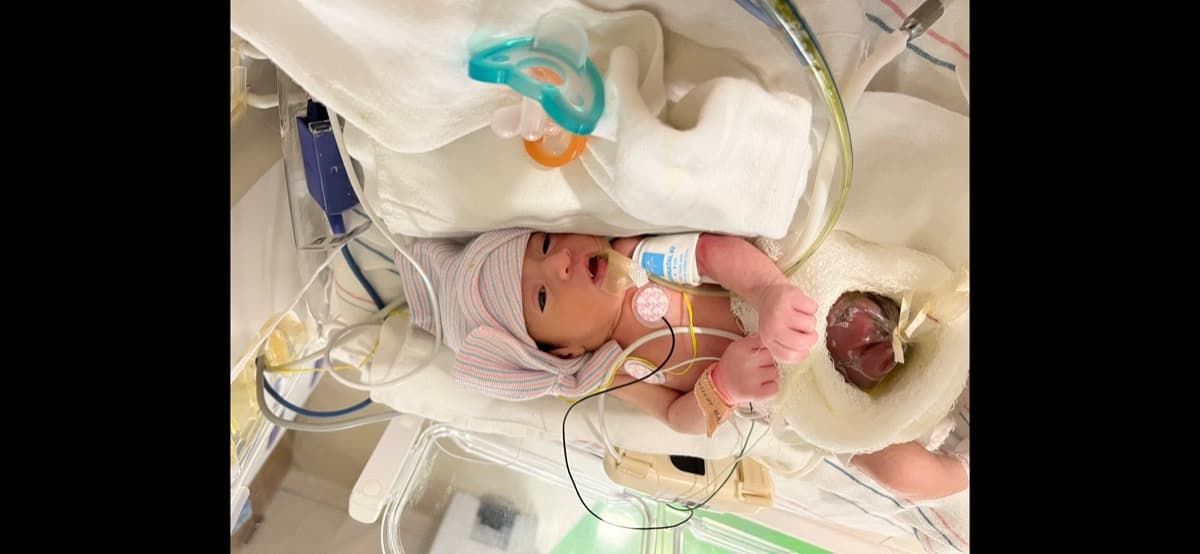 NewbornWithGastroschisis