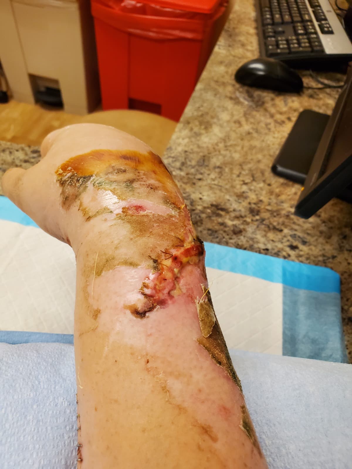 BrokenArm