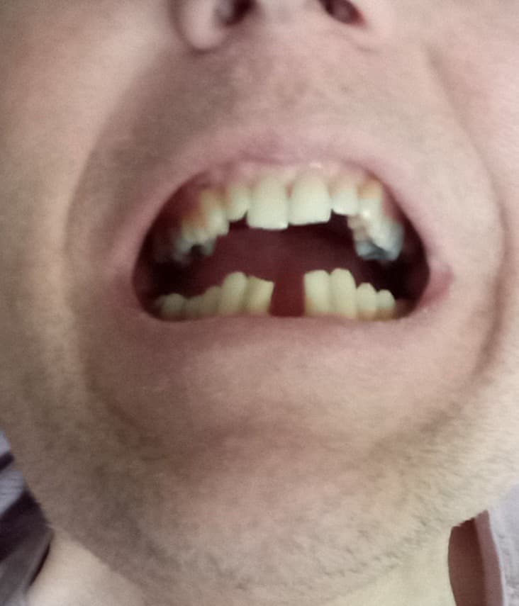 Missing Teeth