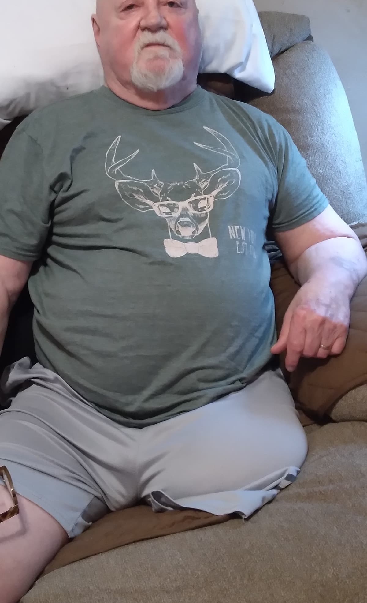 AProstheticLeg