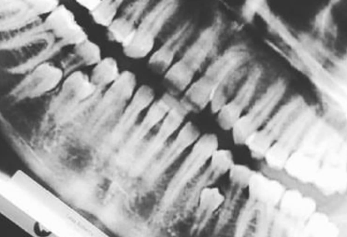 ExtraTeethAndJawSurgery