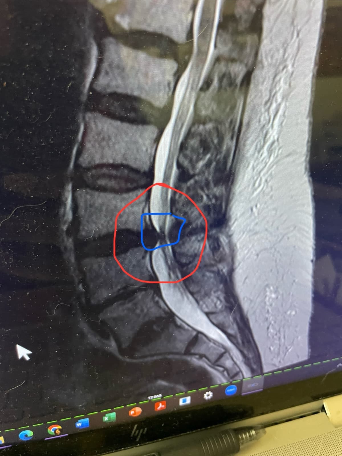 MySpinalSurgery