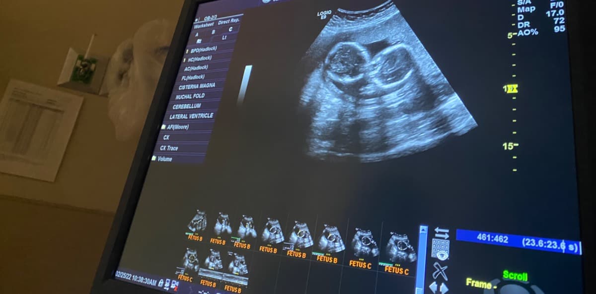 ConjoinedTripletsSurgery