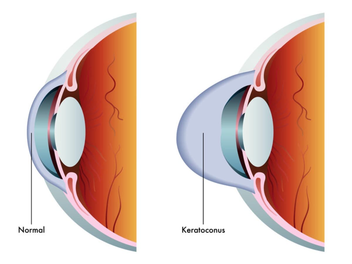 KeratoconusSurgery