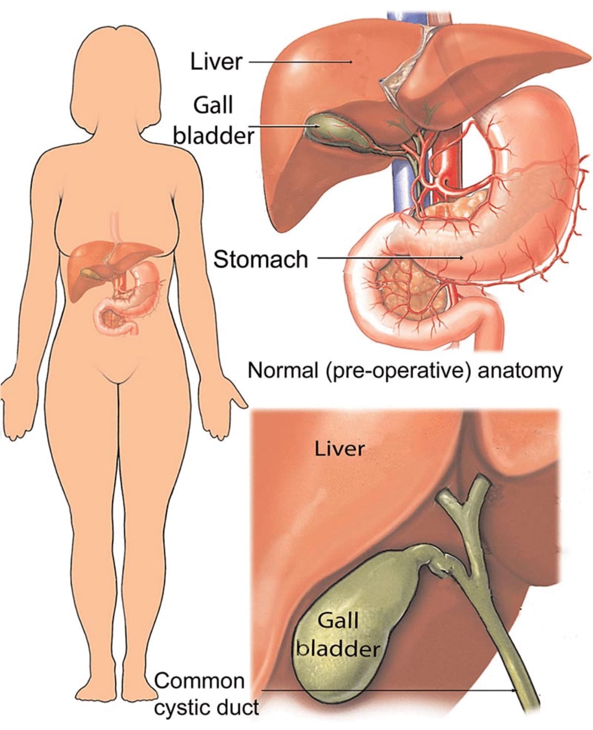 GallbladderRemovalSurgery